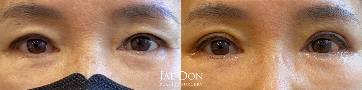 Upper Eyelid