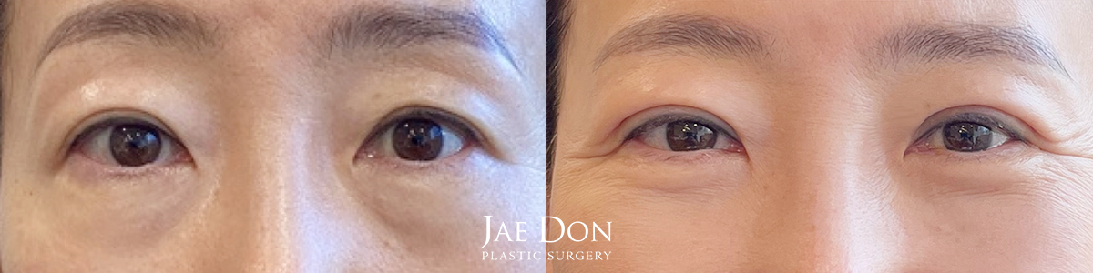 Upper Eyelid